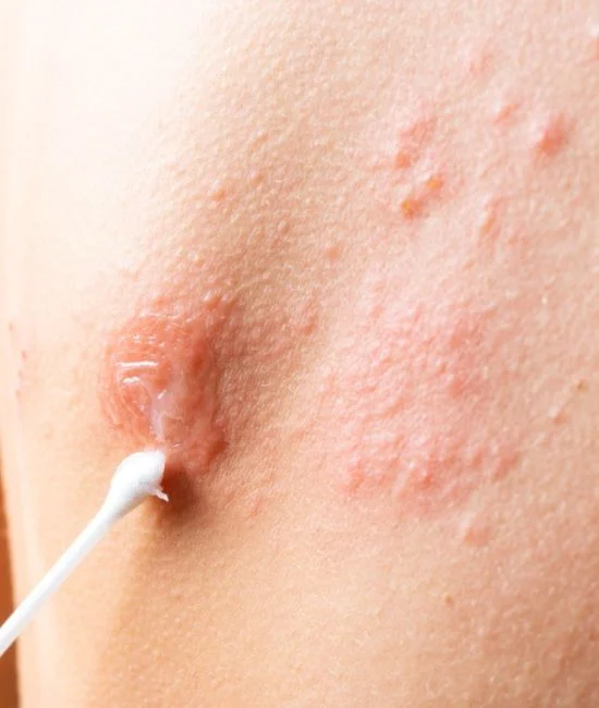 shingles