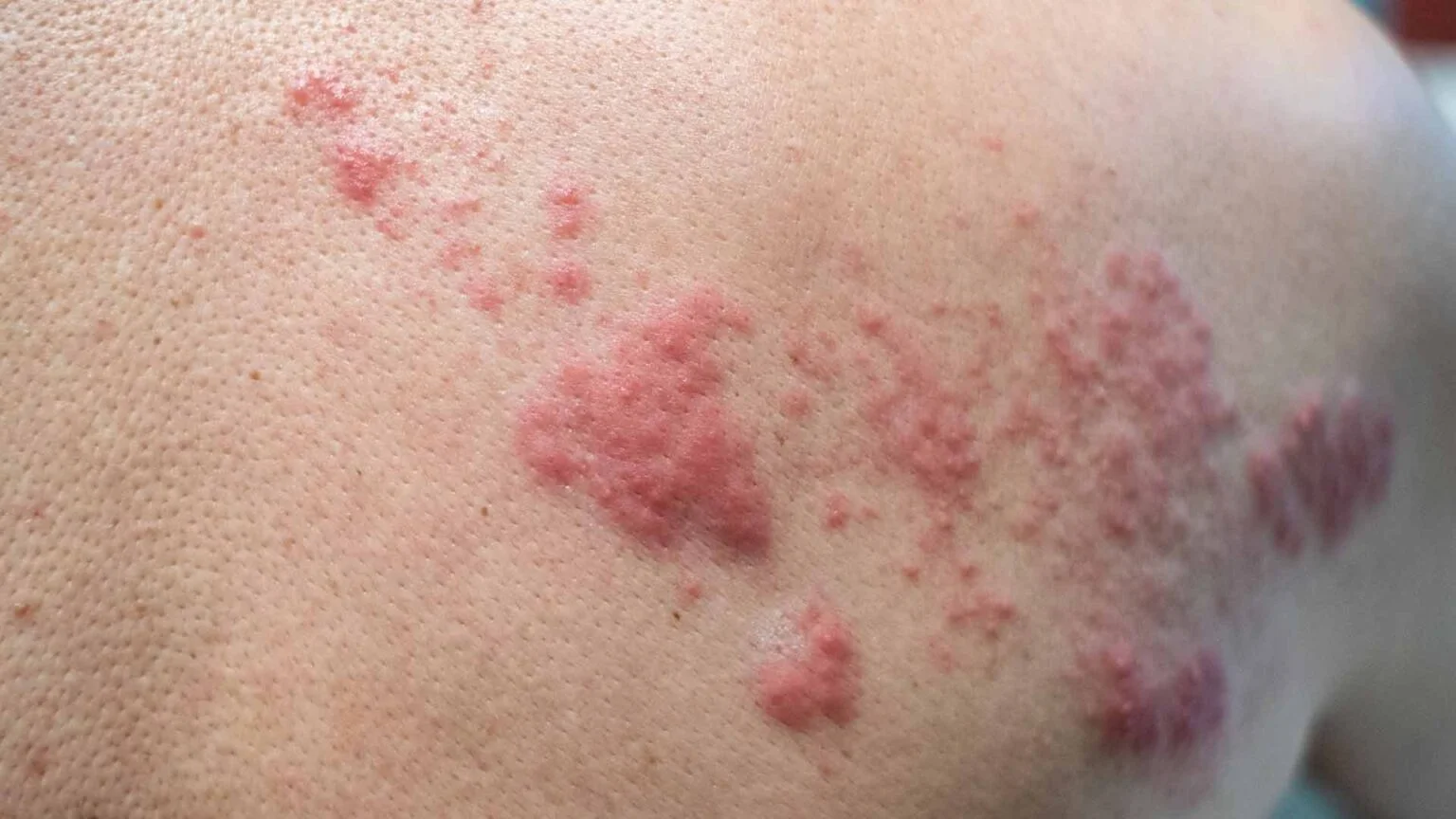 shingles2